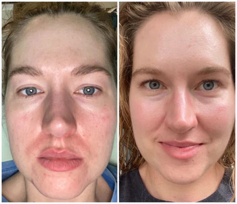 Retinoid Before And After Transform Your Skin With Tretinoin Results Retinoid Before And After Transform Your Skin With Tretinoin Results
